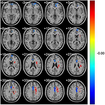 Altered Brain Activity in Patients With Comitant Strabismus Detected by Analysis of the Fractional Amplitude of Low-Frequency Fluctuation: A Resting-State Functional MRI Study